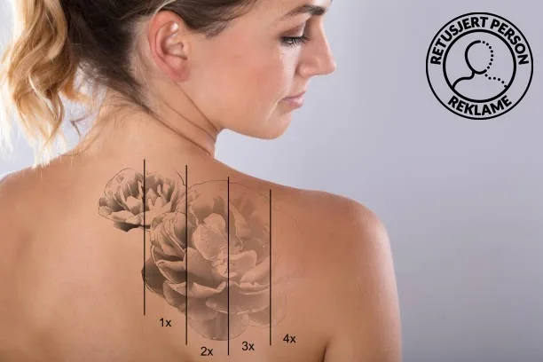 Tatovering på skulderen som blekner etter flere behandlinger